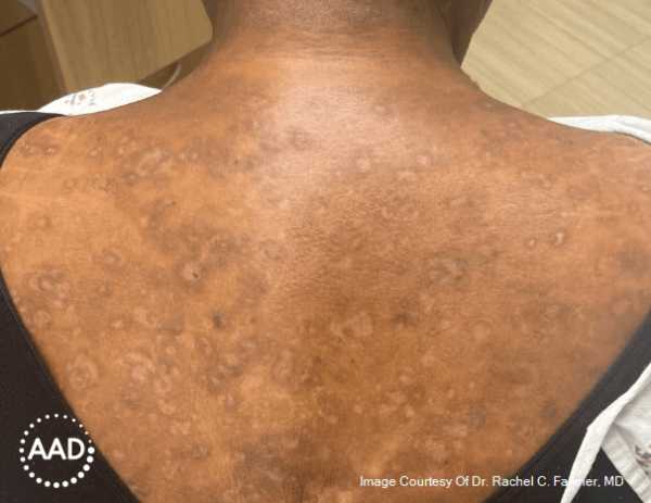 Postinflammatory hyperpigmentation on Black skin